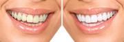 teeth whitening before and after