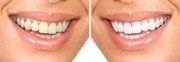 teeth whitening before and after